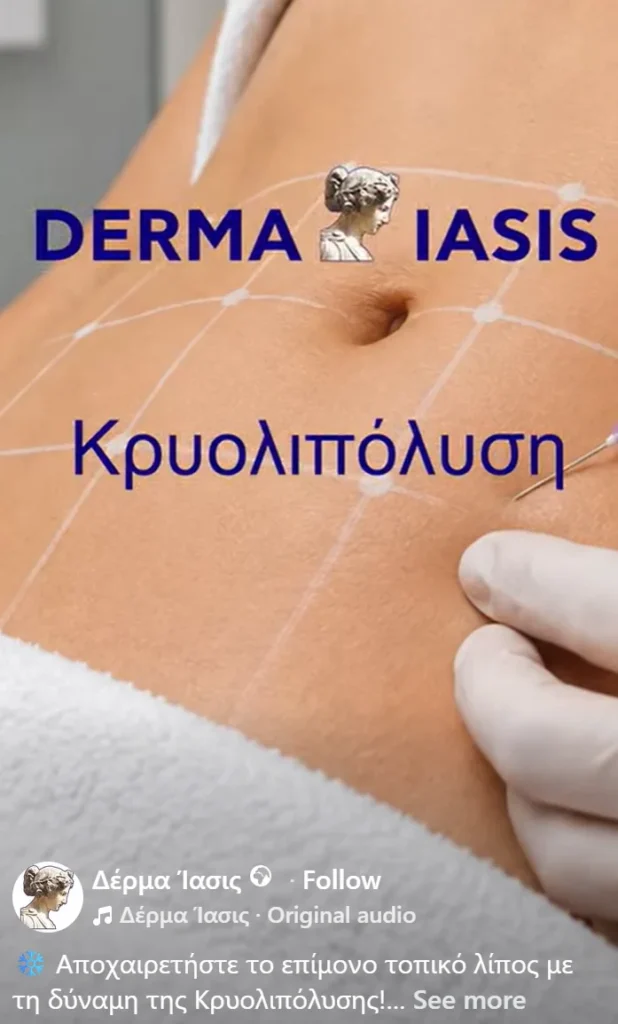 Κρυολιπόλυση Δέρμα Ίασις